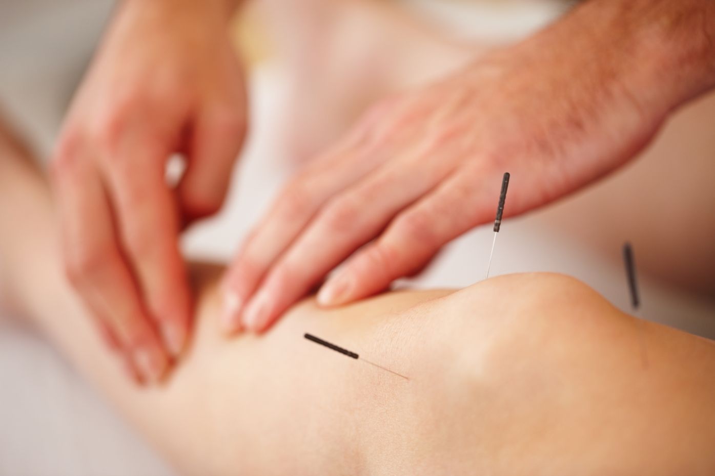 image of acupuncture needles in skin